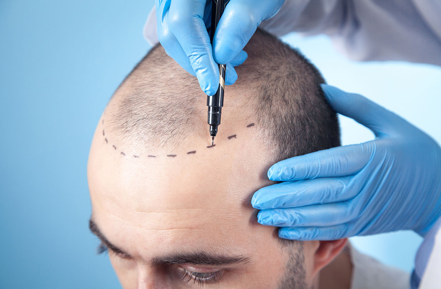 HairScience_Hair-transplant-preparation